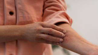 Mulher coçando o braço com a doença de disidrose