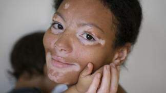 Mulher com vitiligo