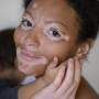 Mulher com vitiligo